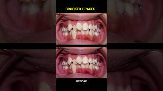 Brcaes For Super Crooked Teeth