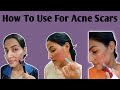 How to use them on acne scars  acne scars chiken pox scars scars