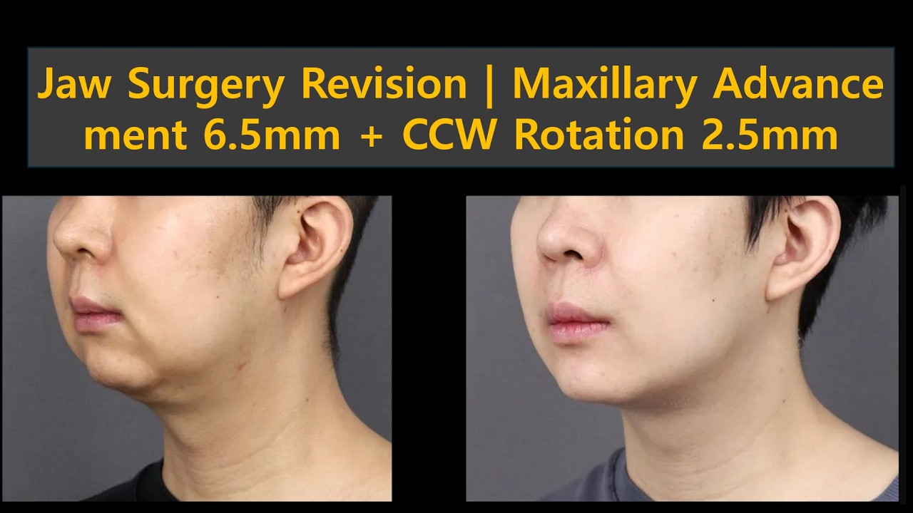 Jaw Surgery Revision | Maxillary Advancement 6.5mm + CCW Rotation 2.5mm | Fixing Over-Retracted Jaw
