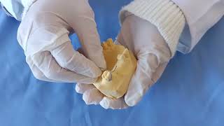 Façonnage Dun Crochet Sur La Molaire Avec Un Fil Demi Jonc