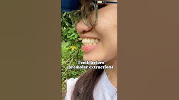 Premolar Extractions Before and After #dentalshorts #orthodontictreatment
