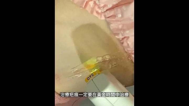 手術疤痕、剖腹疤痕去除！美上美皮膚科幫您解決不美觀的疤！#shorts - 天天要聞