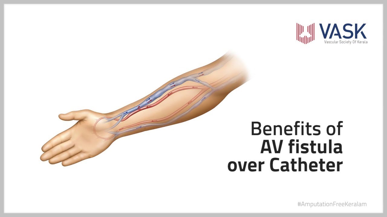 Benefit of AV Fistula over Catheter in Dialysis Access Surgery HEALTH