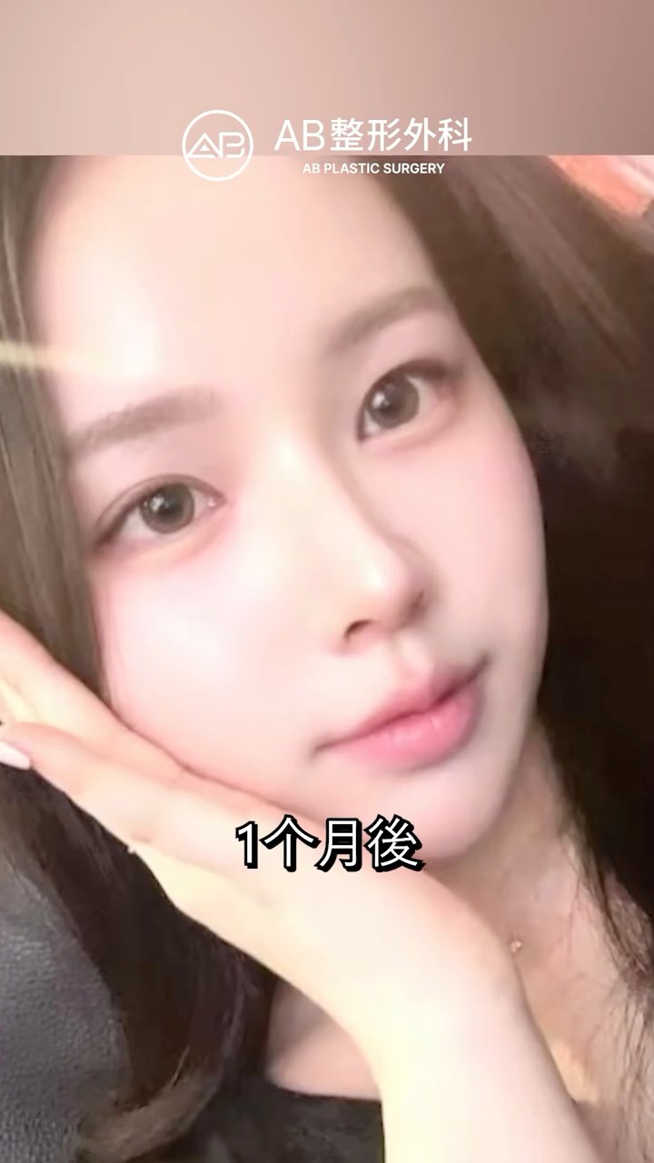 眼整形後變得更漂亮了✨ #Shorts