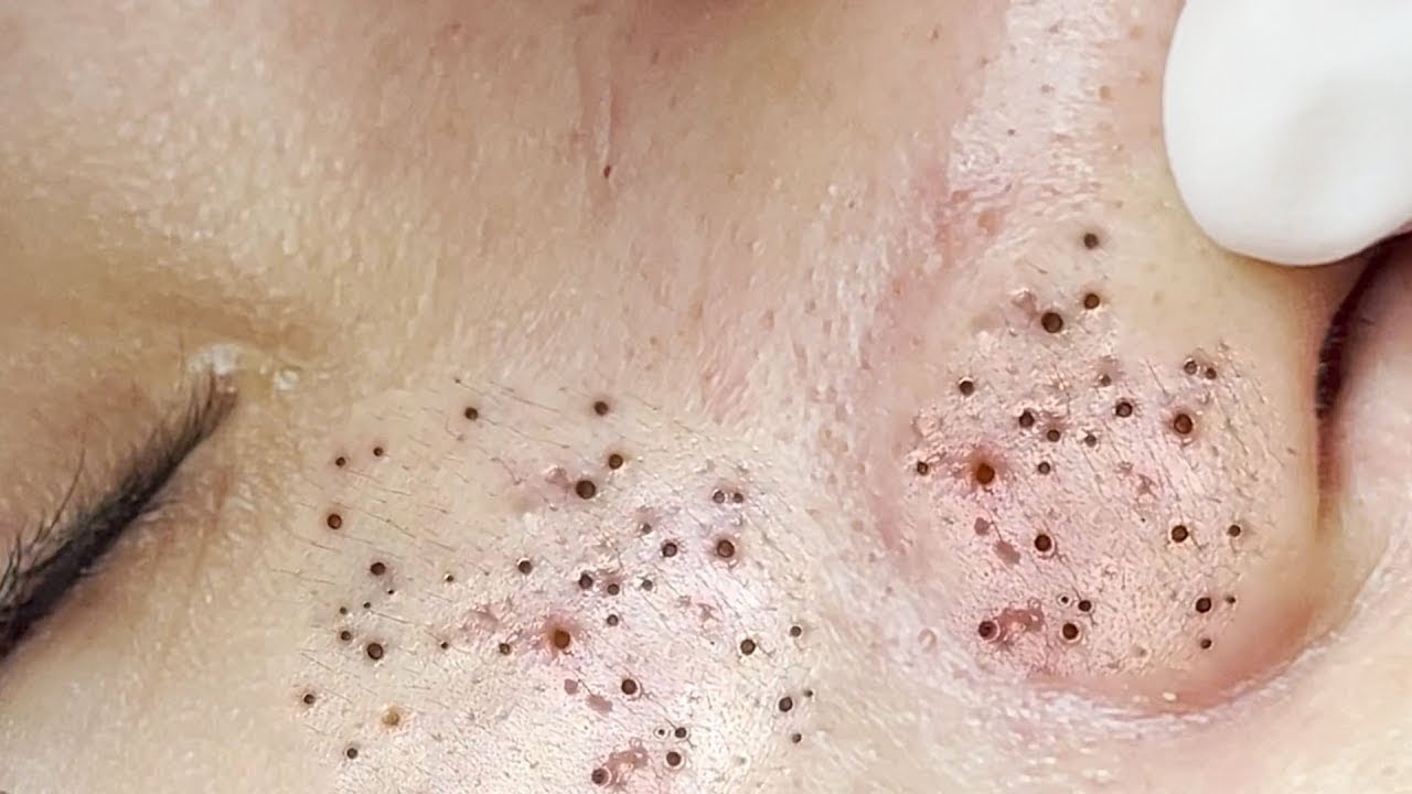 acne-pimple-popping-huge-blackheads-and-giant-pimples-best-pimple