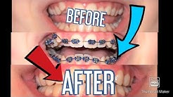 Braces timelapse! 