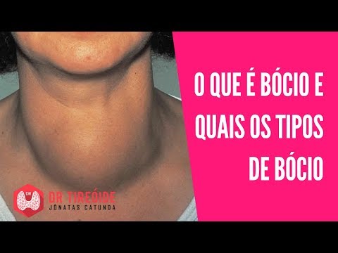 Vídeo: Bócio - Causas, Sintomas, Diagnóstico E Tratamento Do Bócio