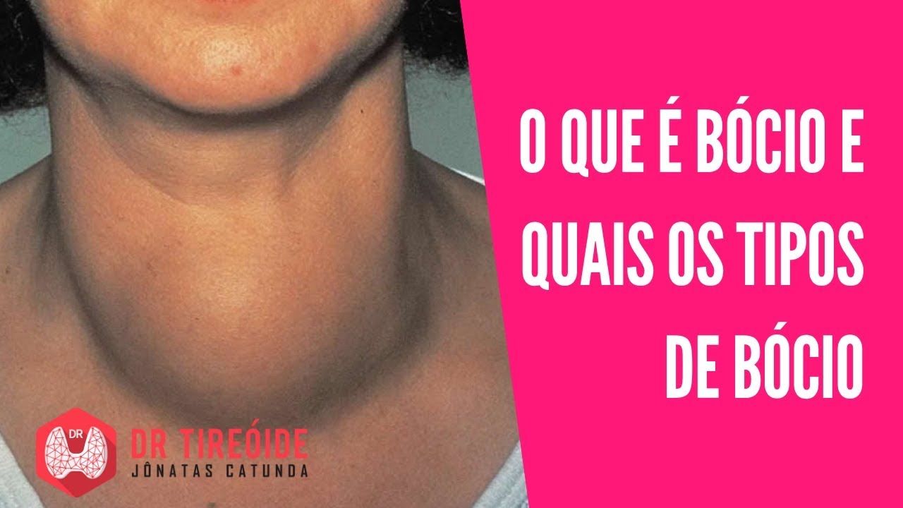 bocio multinodular difuso sintomas