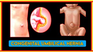 congenital umbilical hernia || gastrointestinal system  #gastrointestinal