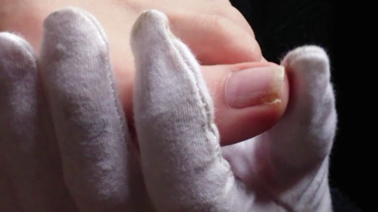 閲覧注意 巻き爪 爪を薄くしてみよう 巻き爪なおるらしい Youtube