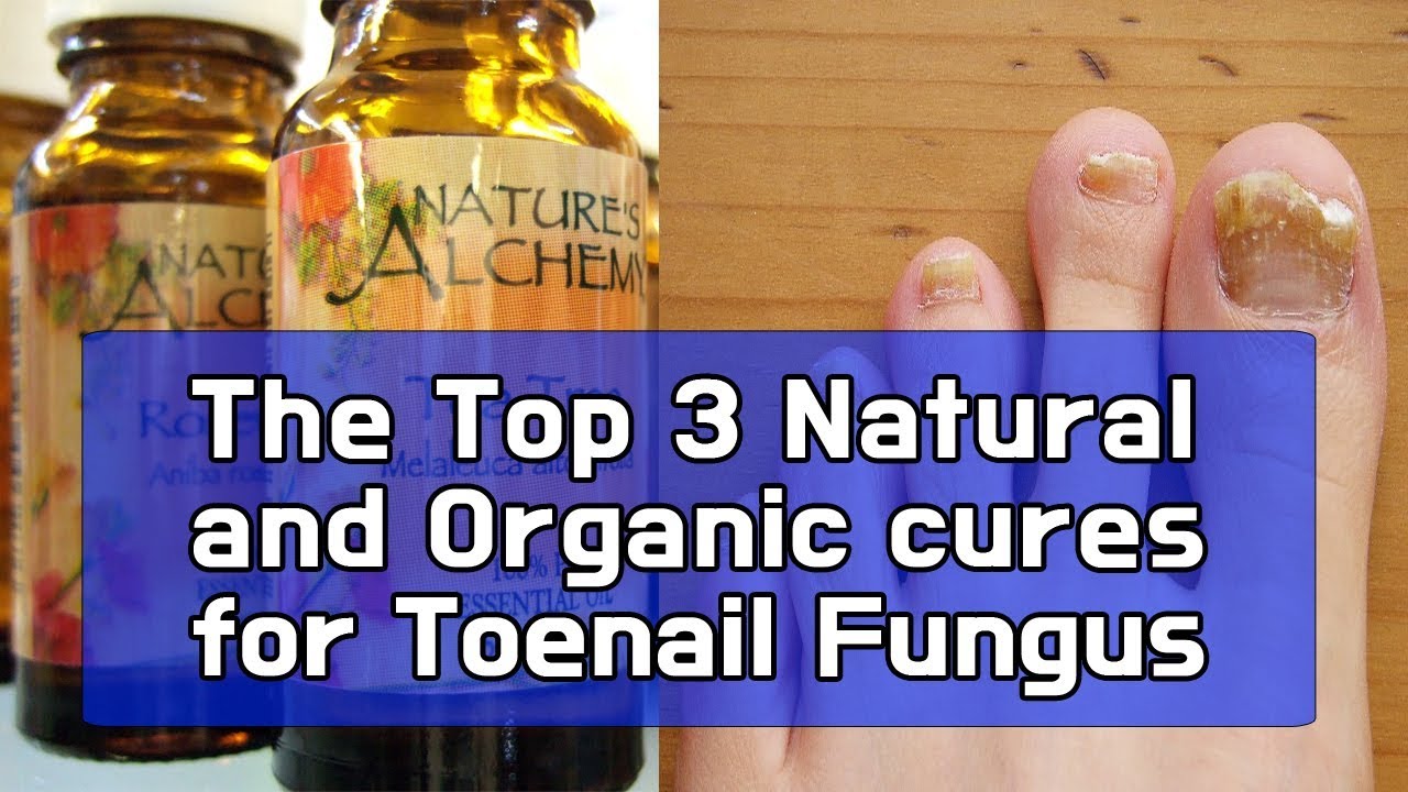 The Top 3 Natural and Organic cures for Toenail Fungus YouTube