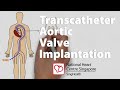 Transcatheter Aortic Valve Implantation (TAVI)