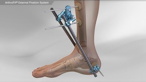 ArthroFX® External Fixation System