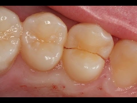 Segera Periksakan Ini 8 Jenis Gigi Patah dan Cara Penanganannya
