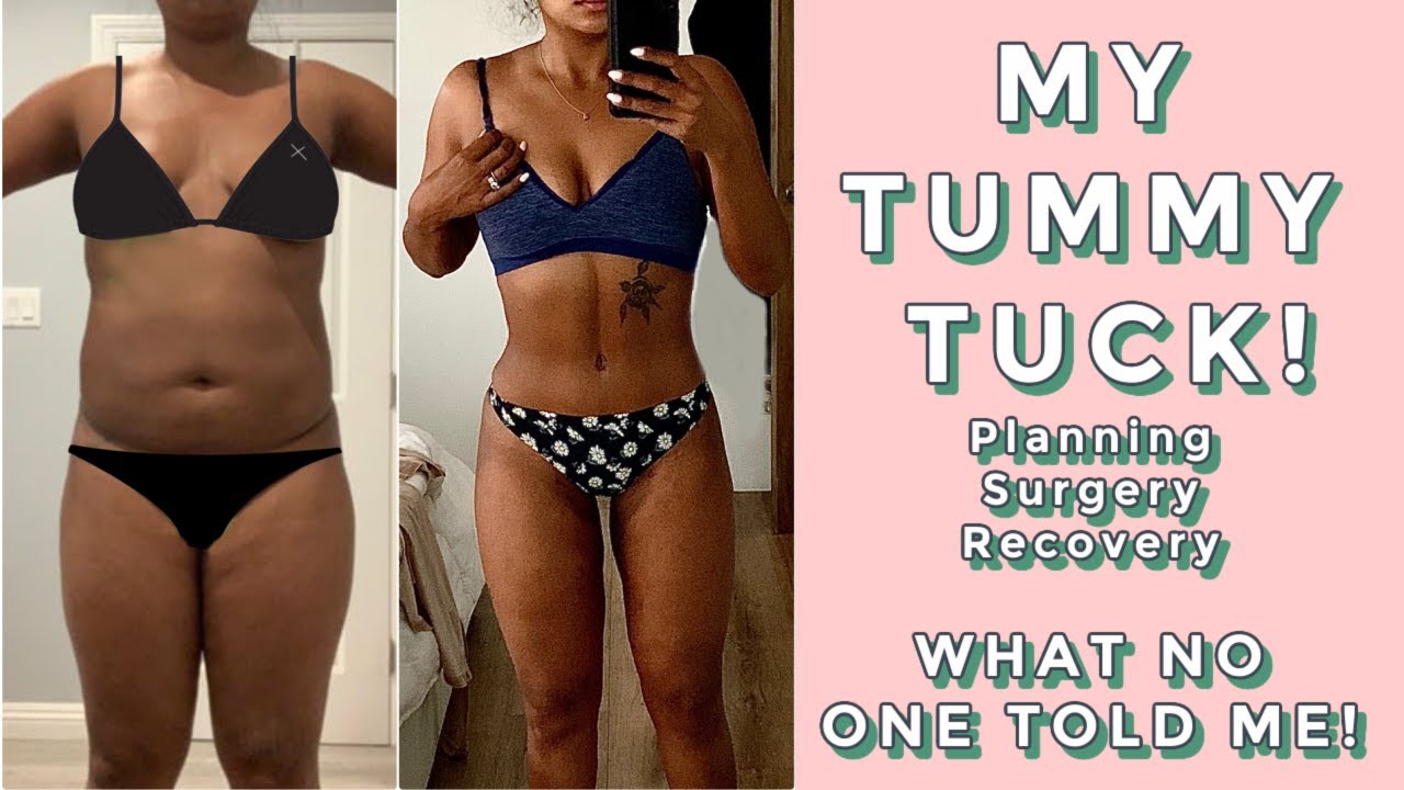 my tummy tuck journey