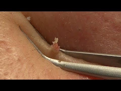 Pimple popping, "Treatment for acne vulgaris using a surgical technique"