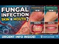 Fungal infections of skin and mouth #neetmds #dentallectures #dentlecthub