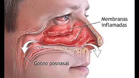 ¿Mucinex elimina el goteo nasal?