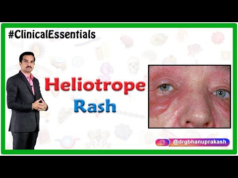 Heliotrope rash in Dermatomyositis - Clinical Essentials