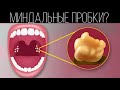 Как лечить миндальные пробки? | ПОЛЕЗНЫЙ ЮТУБ