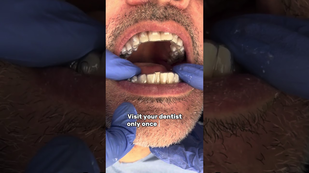 Invisalign Treatment Process at Shmile Dental Clinic - Dentist in Bromley London