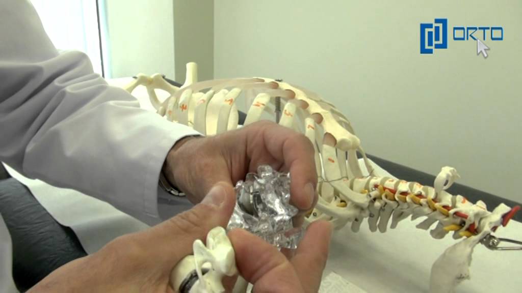 Kad ir nepieciešama mugurkaula disku nomaiņas operācija?