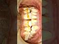 #anbu laser dental clinic #dentist #dentist #dentalartistry #dentist #satisfying