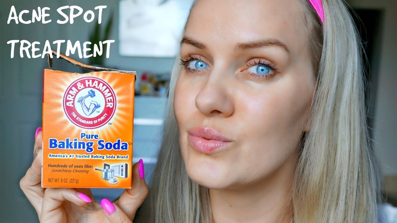 Does baking soda help pimples