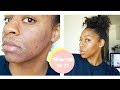 I GOT A CHEMICAL PEEL | POST PEEL UPDATE ! Was it worth it? New Skincare Products + FAQ (answered)