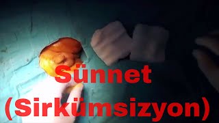 Sünnet Operasyonu Cerrahi Eğitim (Uyarı: Gerçek Görüntü) - Circumcision Surgeryeducational Resimi