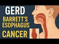 GERD &amp; Barrett's Esophagus Explained |Complete Pathophysiology, Diagnosis &amp; Management