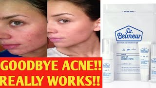 ||How to get rid off acne?The Face Shop Dr.Belmeur 3-Step Kit Review ||