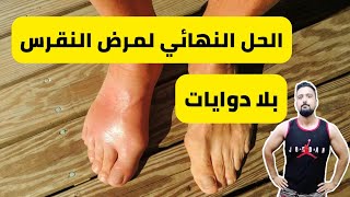 الحل النهائي لمرض النقرس بدون أدوية