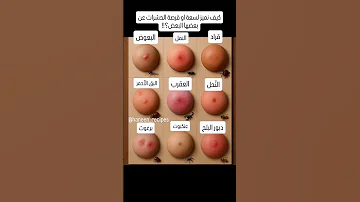 كيف نميز لسعة او قرصة الحشرات عن بعضها حشرات Bugsbite Insects Explore Trendingshorts اكسبلور 