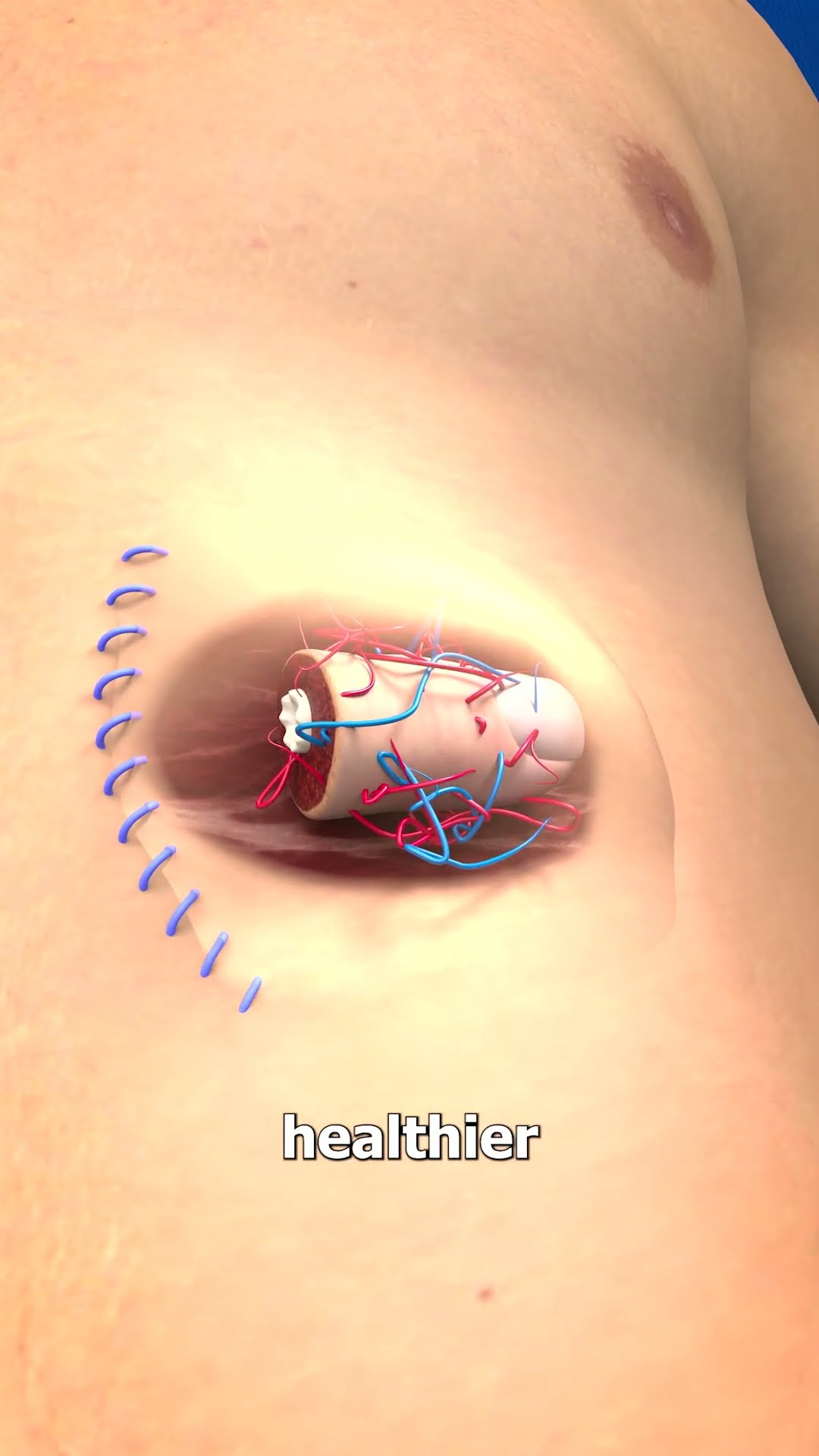 How Abdominal Pocketing Works ?
