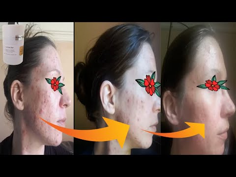 Jenny ~ Cystic Acne ~ Lotion Bar Success Story