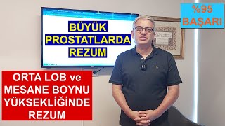 Rezum Tedavisi Orta Lobu Ve Mesane Boynu Yüksek Büyük Prostatlara %95 Başarı Ile Uygulanabiliyor