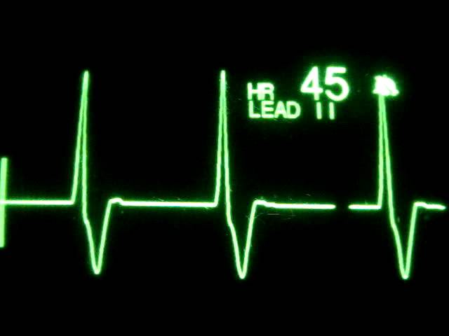 Accelerated Ventricular Rhythm (AVR) class=