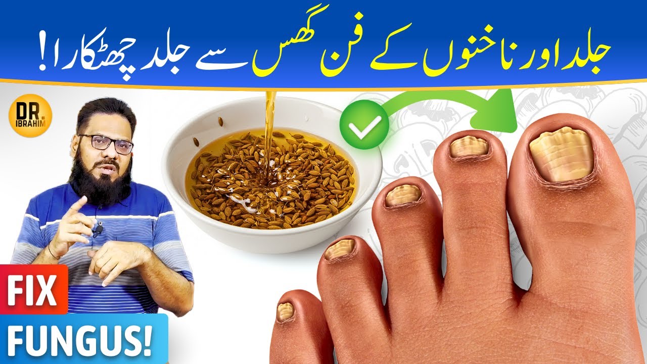 Daad Skin Problem Fungal Infection Ka Mukamal Ilaj | Daad, Toe Nail Fungus & Skin ...