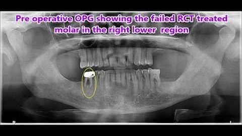 Failed RCT molar extraction & immediate basal implantology