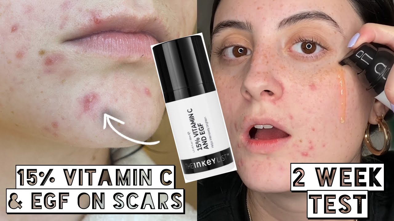 praktisk excitation magnet TESTING The Inkey LIST 15% Vitamin C & EGF on Acne Scars & Dry, Sensitive  Skin for 2 Weeks!! - YouTube