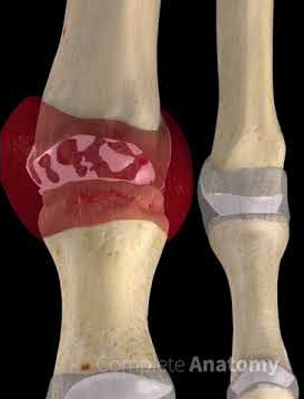 Metatarsal Gout | by Complete Anatomy
