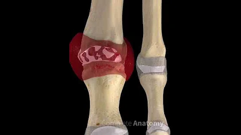 Metatarsal Gout | by Complete Anatomy - DayDayNews
