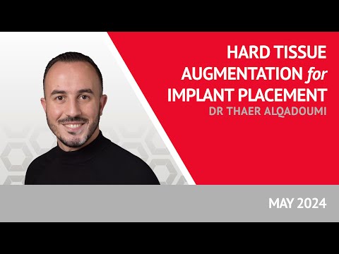 Hard Tissue Augmentation for Implant Placement with Dr Thaer Alqadoumi - video from Osteogenics Biomedical