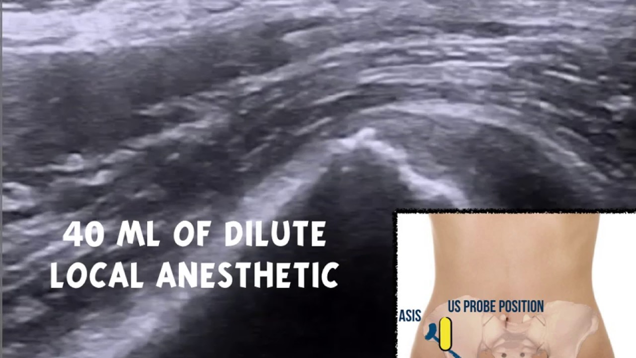 Short clip showing fascia iliaca injection plane