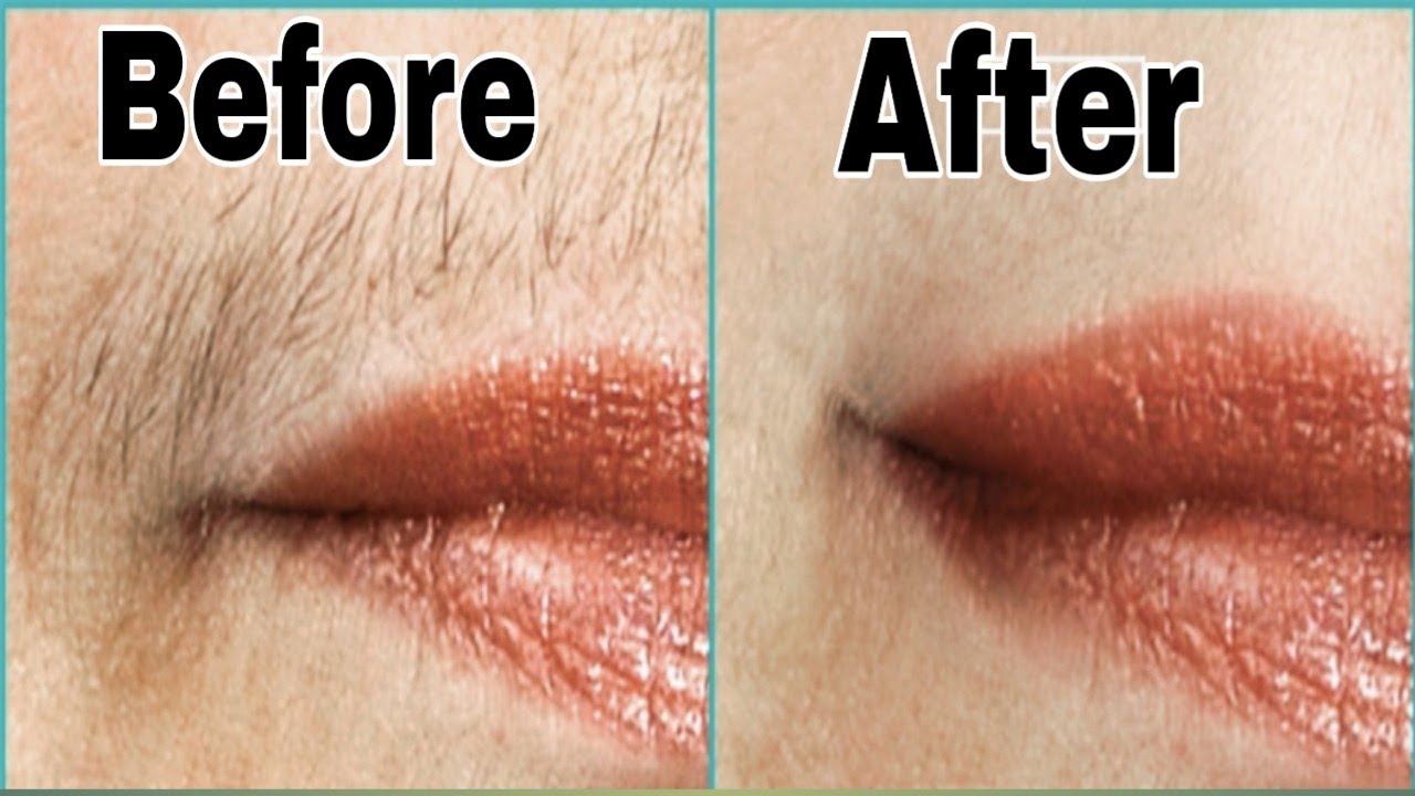 Remove Upper lips Hair Without Threading, Hot Wax, & Razer Remove