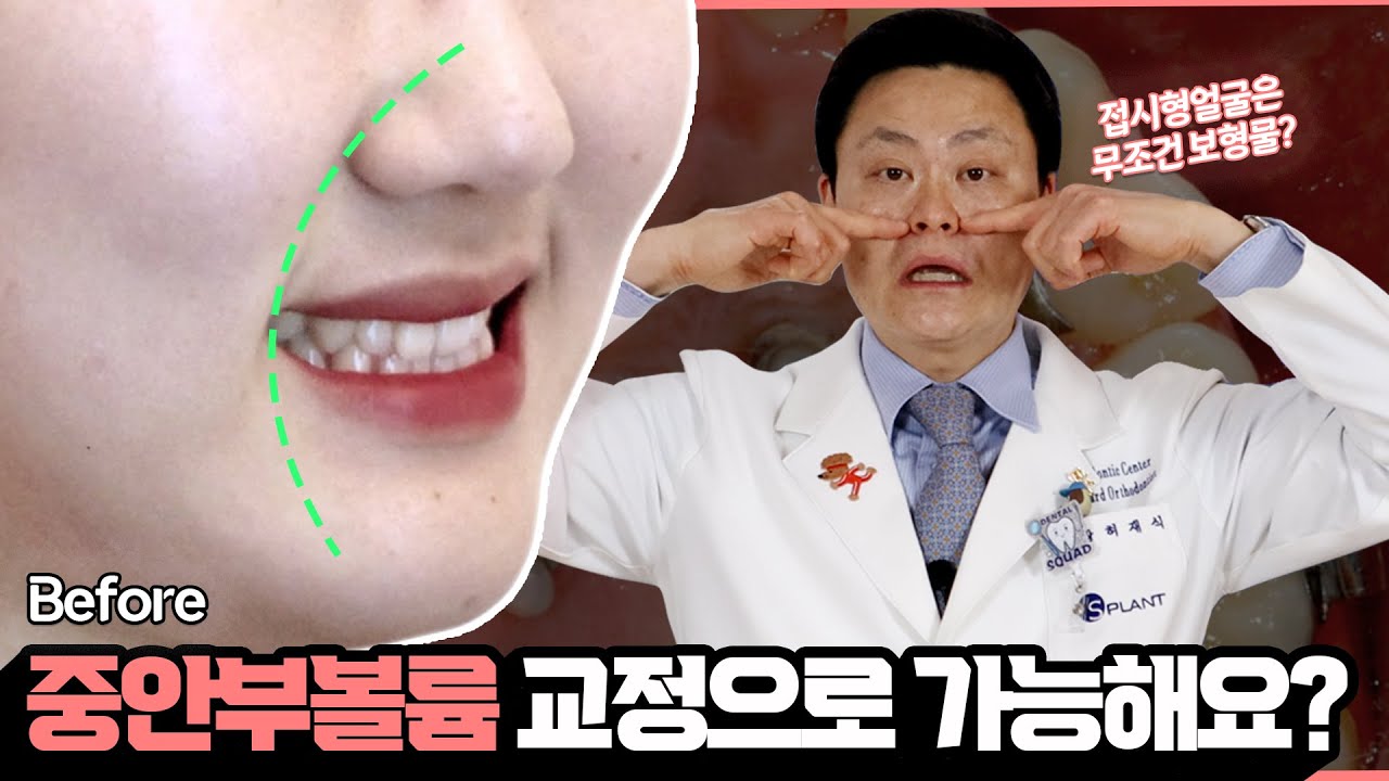 [교정일타 허원장] 중안부볼륨 없는 접시형 얼굴 치아교정으로 해결할 수 있나요?