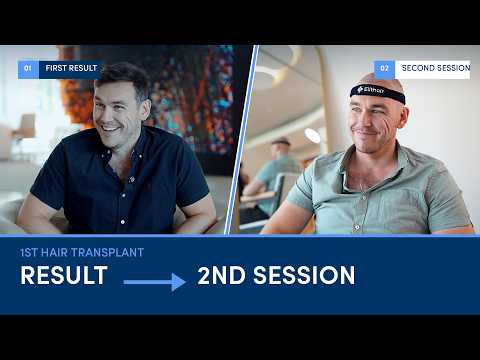 My Second Hair Transplant at Elithair in Turkey | Michael’s Story