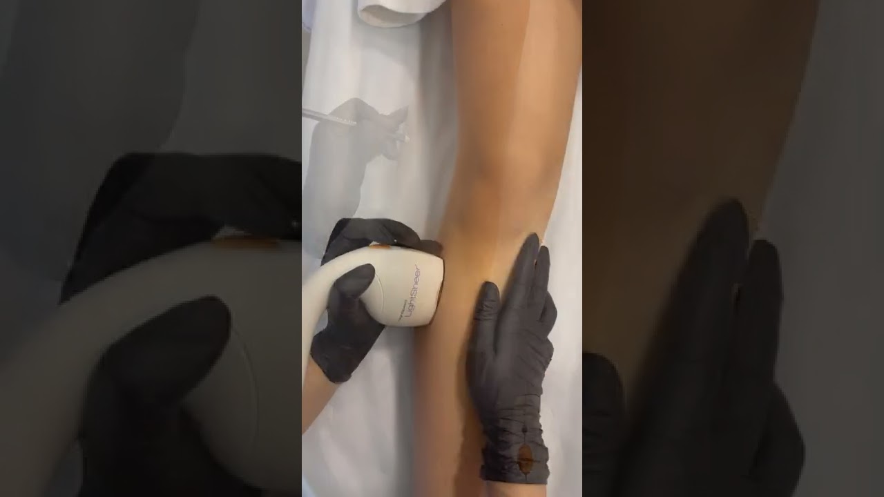 Epilare definitiva cu laser/Lumenis Lightsheer Desire