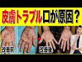 【実症例で解説】皮膚のトラブルと歯周病・銀歯・虫歯で根が膿んでる問題の深い関係とは?